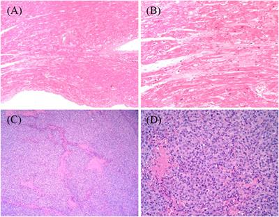 Case Report: Diffuse Large B Cell Lymphoma After Cardiac Transplantation due to Anthracycline-Induced Dilated Cardiomyopathy in Pediatric Acute Lymphoblastic Leukemia